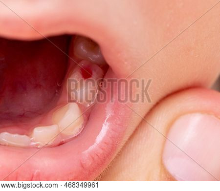 Installation Of A Colored Red Filling In A Milk Tooth For A Child. Colored Fillings In Dentistry For