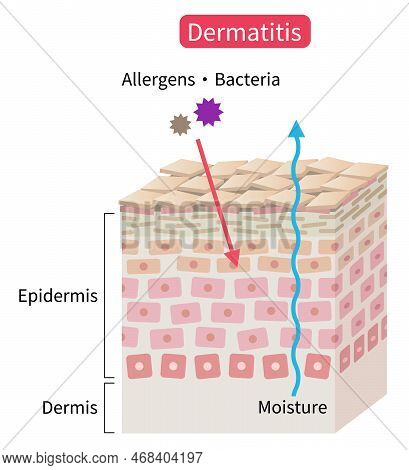 Atopic Dermatitis Dry Skin Skin Cell Layer. Eczema Disrupt Moisture Barrier That Allows Penetrate Ex