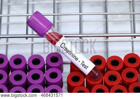 Creatinine Test To Look For Abnormalities From Blood,  Blood Sample To Analyze In The Laboratory, Bl