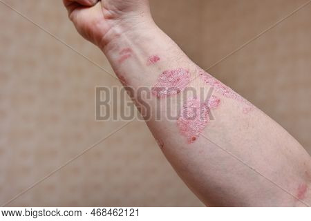 Man With Sick Arm, Dry Flaky Skin On His Hand With Vulgar Psoriasis Sores, Allergy, Eczema And Other