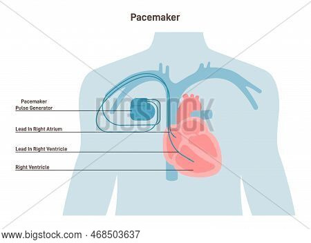 Artificial Cardiac Pacemaker Anatomical Scheme. Medical Device