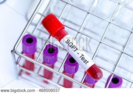 Sgpt Test To Look For Abnormalities From Blood,  Blood Sample To Analyze In The Laboratory, Blood In