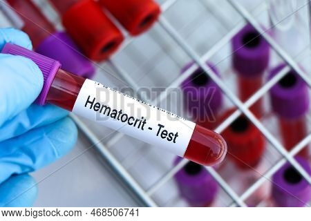 Hematocrit Test To Look For Abnormalities From Blood,  Blood Sample To Analyze In The Laboratory, Bl