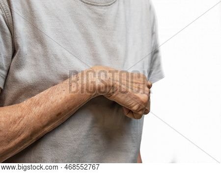 Volkmann Contracture In Left Upper Limb Of Southeast Asian Old  Woman. It Is A Permanent Shortening 