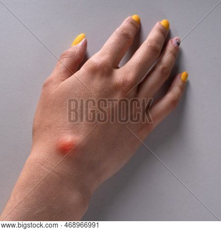 Ganglion Cyst On Woman Hand On White Background