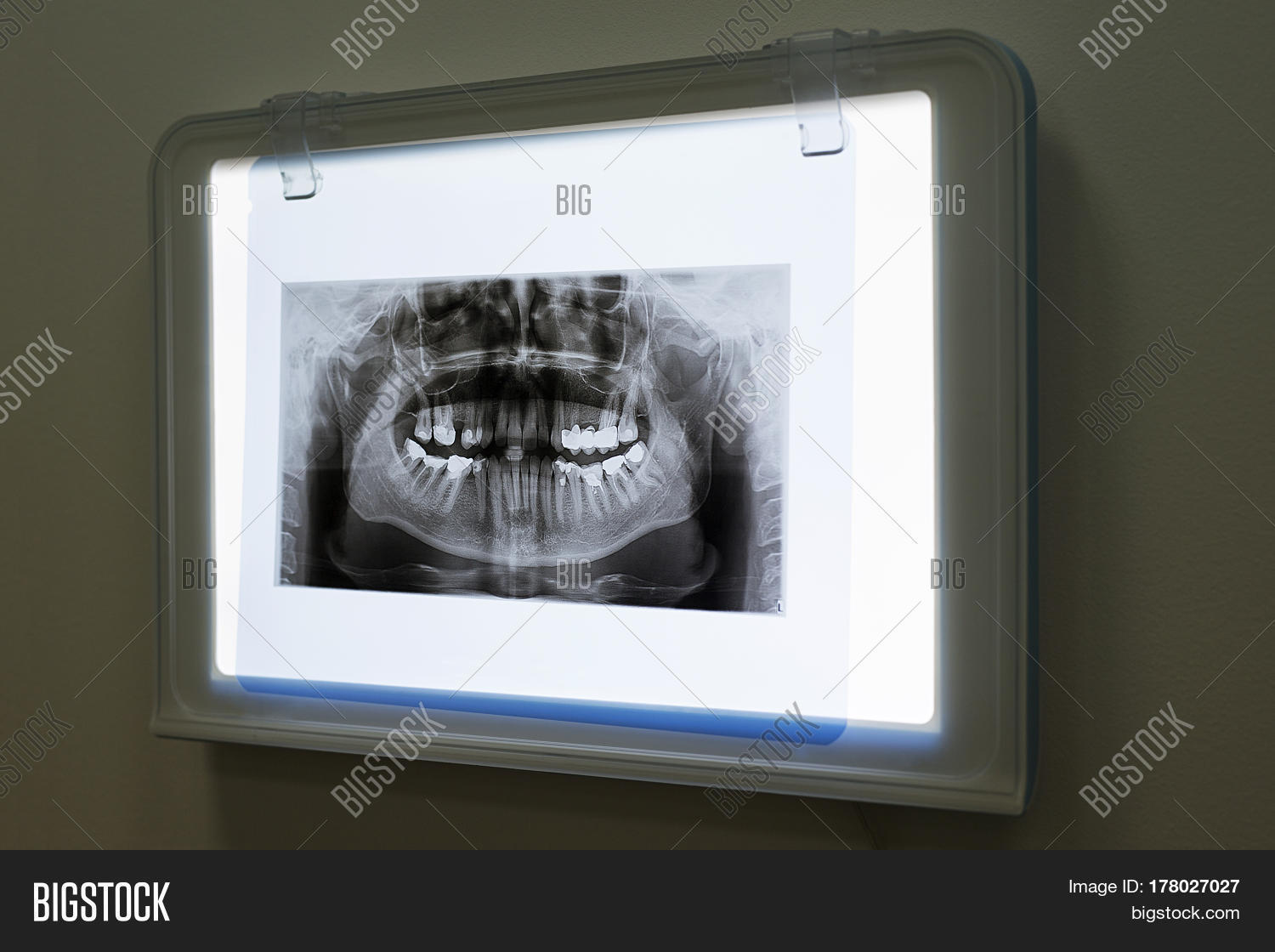 Xrays Jaw Teeth Image & Photo (Free Trial) Bigstock