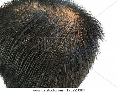 Characteristic symptoms of thinning hair,Glabrous,bald head on white blackground