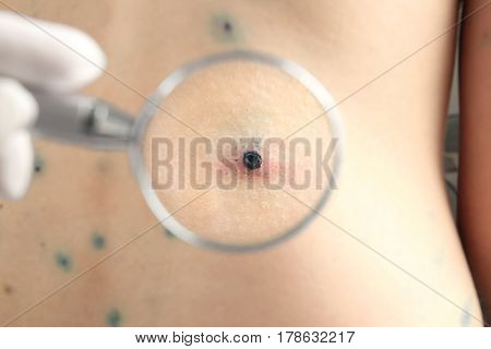 Dermatologist looking at skin of human with chicken pox through magnifier, closeup
