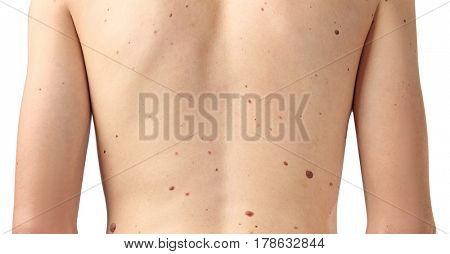 Young man with birthmarks on light background, closeup