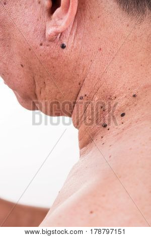 Multiple Mole On Neck And Shoulder Of Asian Male