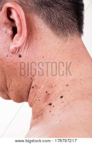 Multiple Mole On Neck And Shoulder Of Asian Male