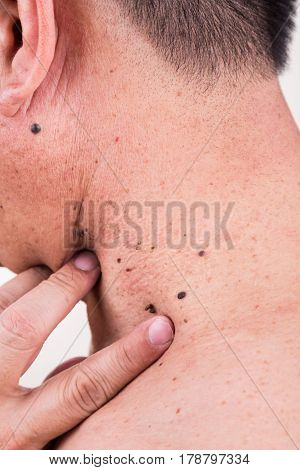 Finger Embrace Mole On Neck And Shoulder Of Asian Male