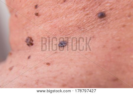 Closeup Of Multiple Moles On Shoulder Of Asian Man
