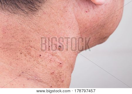 Mole Removed Via Skin Graft Procedure Leaving Scar