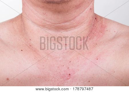 Mole Removed Via Skin Graft Procedure Leaving Scar