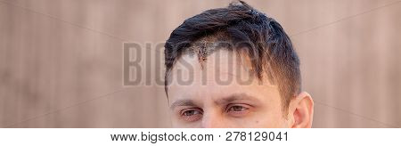 Suture Wound At Skull With Wires, Postoperative Stitching Craniectomy With Many Staples, Medical Sew