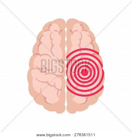 Human Brain With Epilepsy Activity Isolated On White Background.