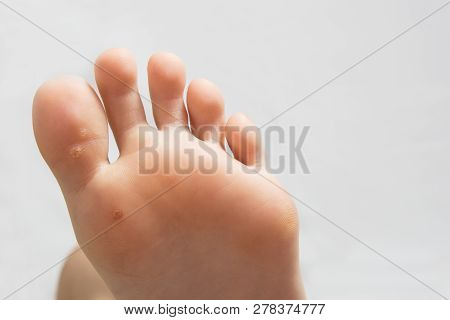 Inspecting Mans Feet With A Large Problem Callus