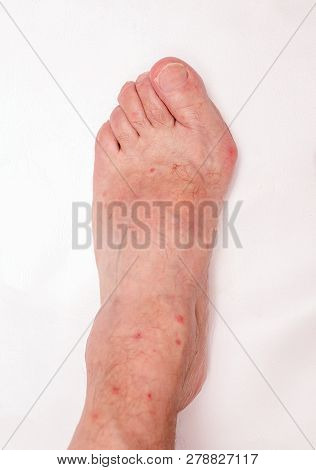 Hallux Abductus Valgus