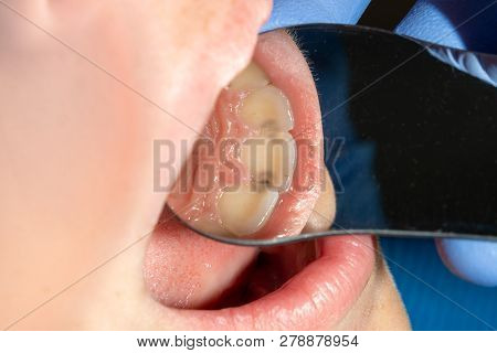 Dental Caries. Filling With Dental Composite Photopolymer Material Using Rabbders. The Concept Of De