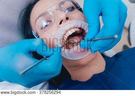 Dental Treatment With Expander. Modern Dental Technology