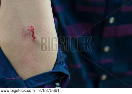 Injuries From Falling In The Garden.\na Man Showing A Lesion On His Arm. Arm Is Wound From A Knife. 