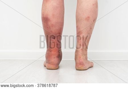 Close Up Photo Of Legs With Lymphostasis From Behind.