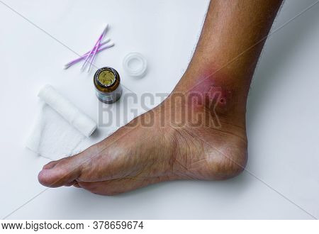 Abscesses Form After Bacteria. Infected Purulent Open Wound On The Mans Foot. Festering Wound Care P