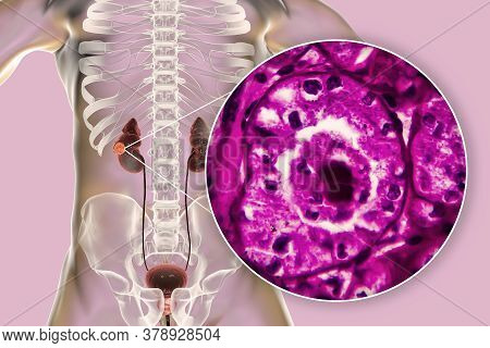 Kidney Cancer, Renal Cell Carcinoma, 3d Illustration And Light Micrograph