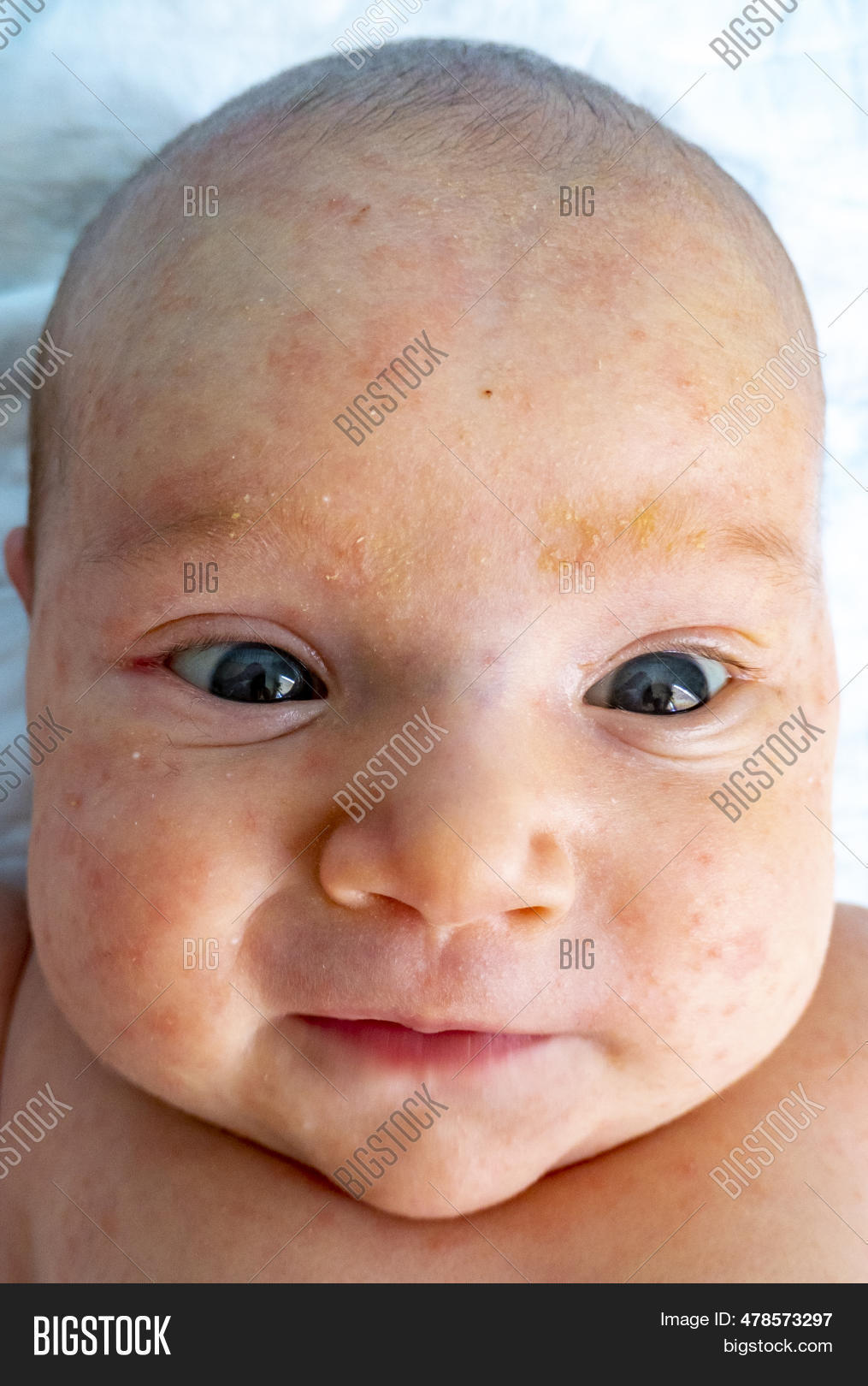 Baby Allergy Skin. Image & Photo (Free Trial) | Bigstock