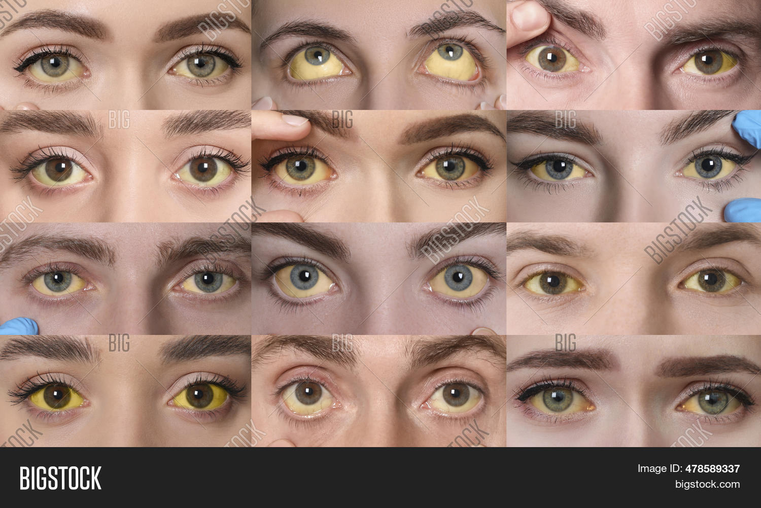 Yellowing Eyes Symptom Image & Photo (Free Trial) Bigstock