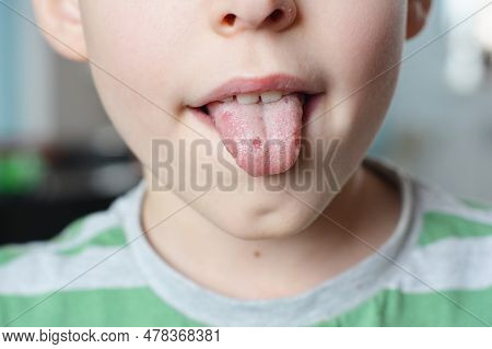 White Spots On The Tongue. Oral Thrush Is A Fungal Infection That Affects The Soft Tissue Inside The