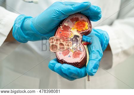Kidney Disease, Chronic Kidney Disease Ckd, Doctor Hold Model To Study And Treat In Hospital.