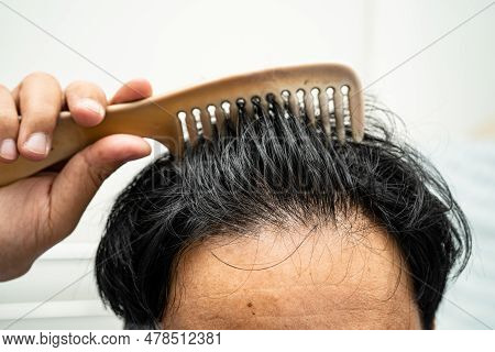 Bald At Front Of Head And Begin No Loss Hair Glabrous Of Mature Asian Business Smart Active Office M