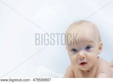 A Baby With A Hemangioma On His Neck Lies On A White Background. Banner With A Copy Space. Profile O