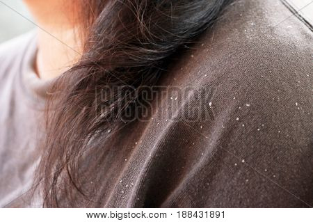 women having dandruff in the hair and shoulder