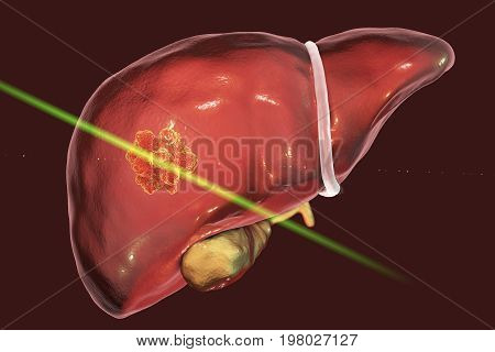 Liver cancer treatment with laser. Conceptual image. 3D illustration
