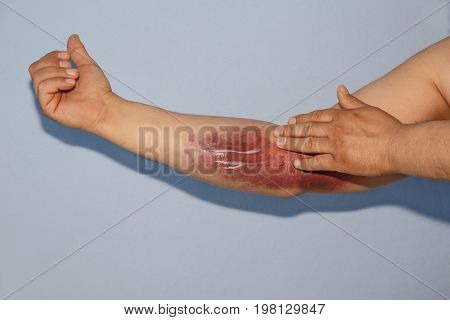 man smears with a hematoma on his elbow