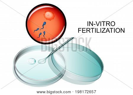 vector illustration of in vitro fertilization. IVF