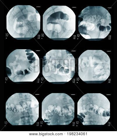 The picture of intestinal abdominal x ray