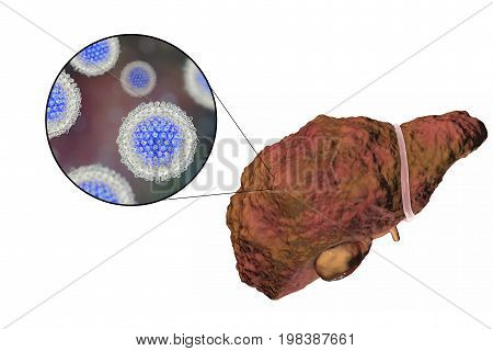 Liver with Hepatitis C infection on the stage of liver cirrhosis and close-up view of Hepatitis C Virus, HCV, 3D illustration