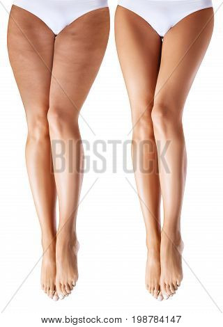 Front view of woman legs before and after treatment. Cellulite problem concept.