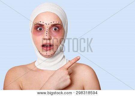 Beautiful Woman Before Plastic Surgery With Bandaged Face. Girl Looks Shocked, Points Fore Finger As
