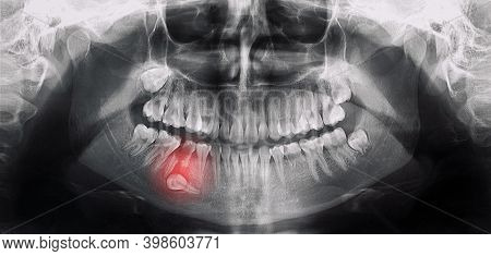 Orthopantomography, Opg X-ray Dr Digital Wisdom Teeth