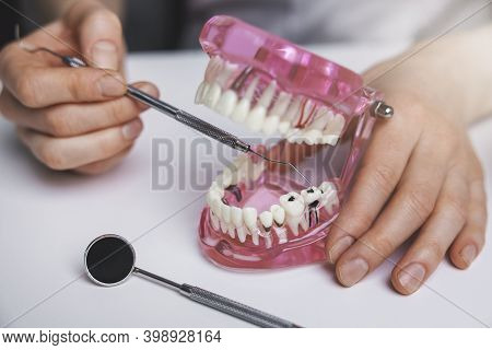 Dentist Showing Dental Caries Tooth Decay On Jaw Model