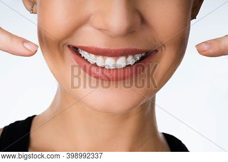 Female Mouth With Metal White Dental Braces Or Brackets