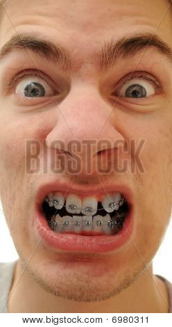 Skæve tænder