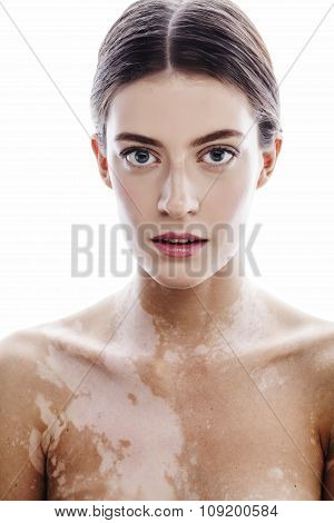 beautiful young brunette woman with vitiligo disease close up isolated on white