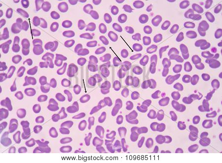Red Blood Cells Ovalocyte.
