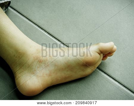 Hand Foot and Mouth disease Closeup allergic rash skin of kids foot.